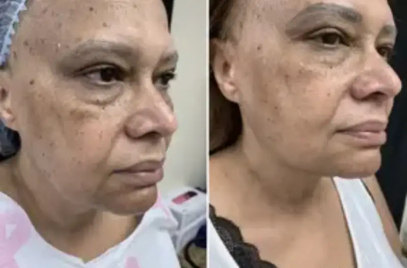 coolsculpting neck cost