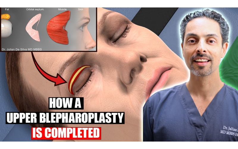 upper blepharoplasty london
