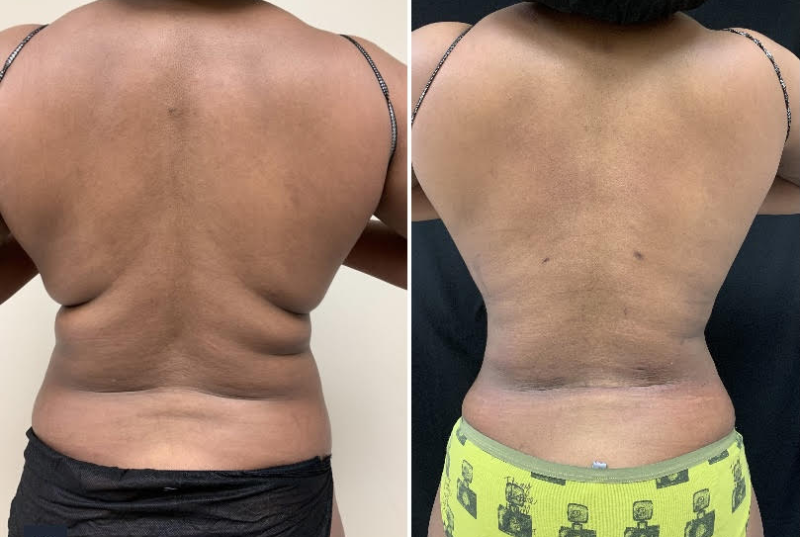 Laser Lipo In DC: Before And After Results Explained