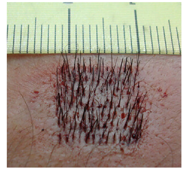 Hair Transplant In Turkey