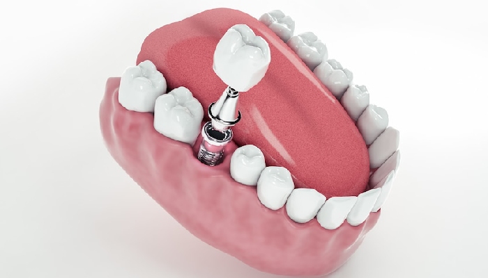 All On 4 Dental Implants Pembroke Pines: Are They Right For You?