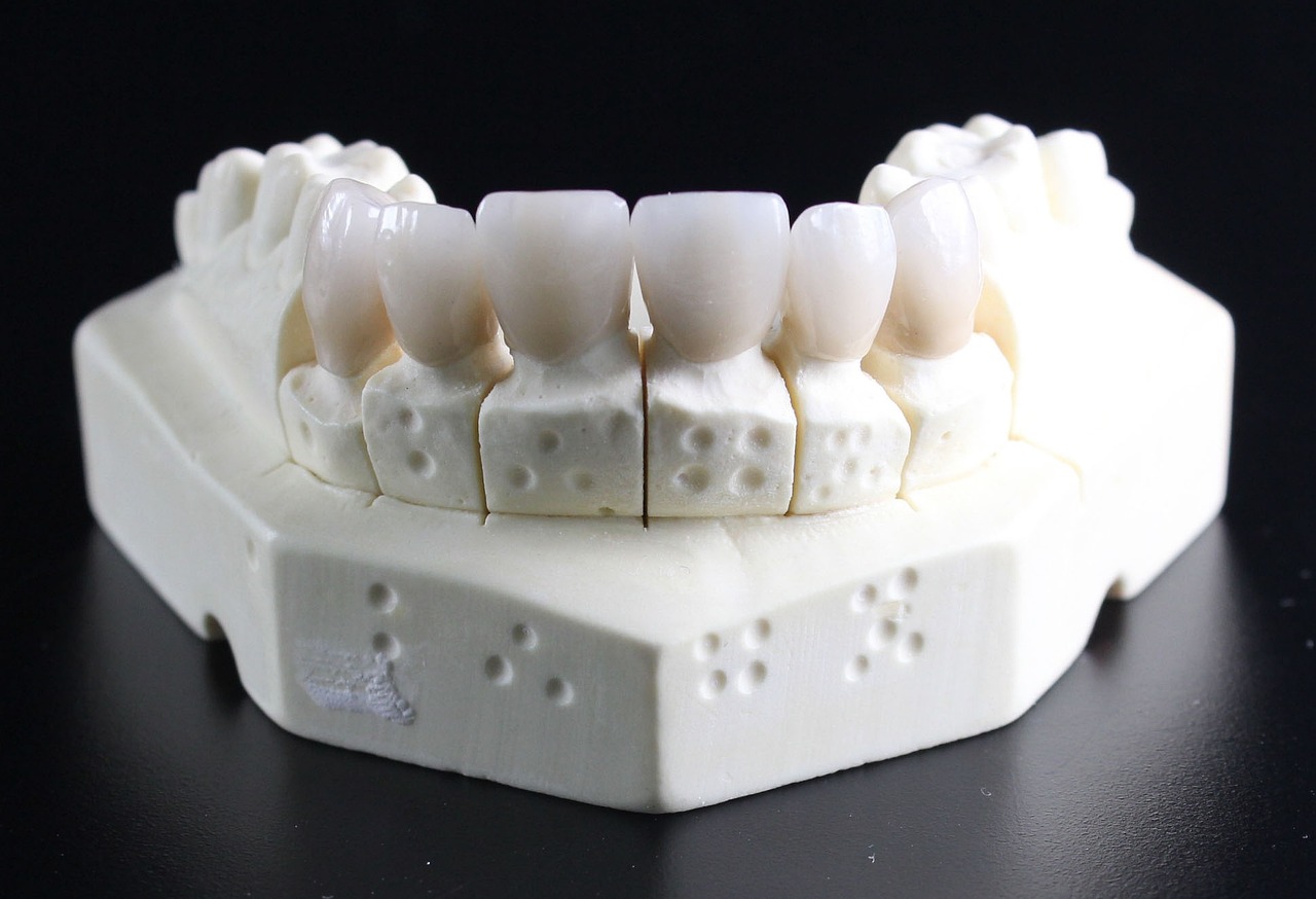 Understanding Dental Bridges In Tucson: A Comprehensive Guide